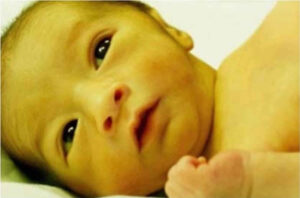 سندرم کریگلر-نجار