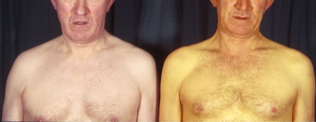 Gilbert syndrome