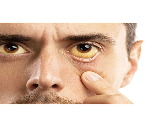 زردی در بزرگسالان