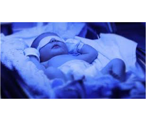 تاثیر دستگاه فتوتراپی بر درمان زردی نوزاد