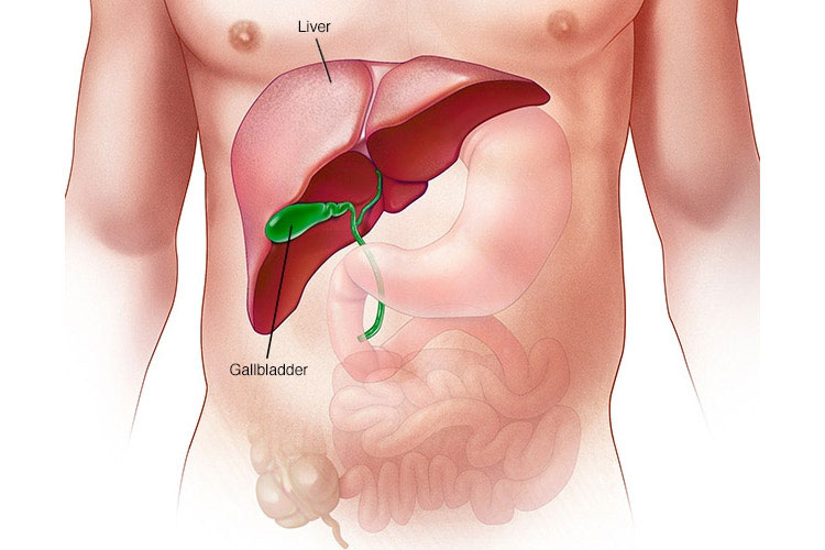 علل و مکانیسم عملکرد سندروم کریگلر-نجار
