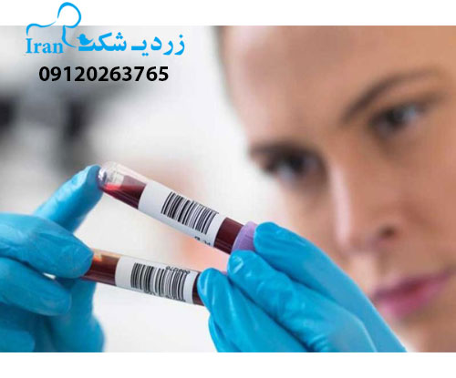 زردی در نوزادان دختر بیشتر است یا نوزادان پسر؟