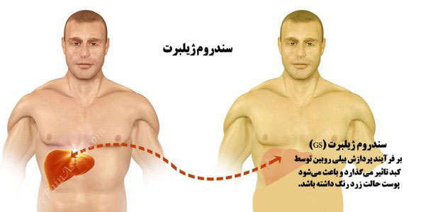 سندروم ژیلبرت